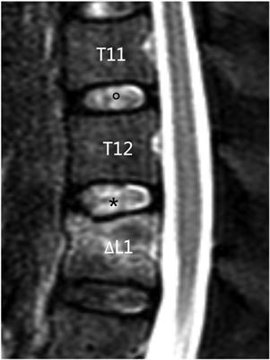 Effect of bone cement distribution on adjacent disc degeneration after vertebral augmentation for osteoporotic vertebral compression fractures in aging patients